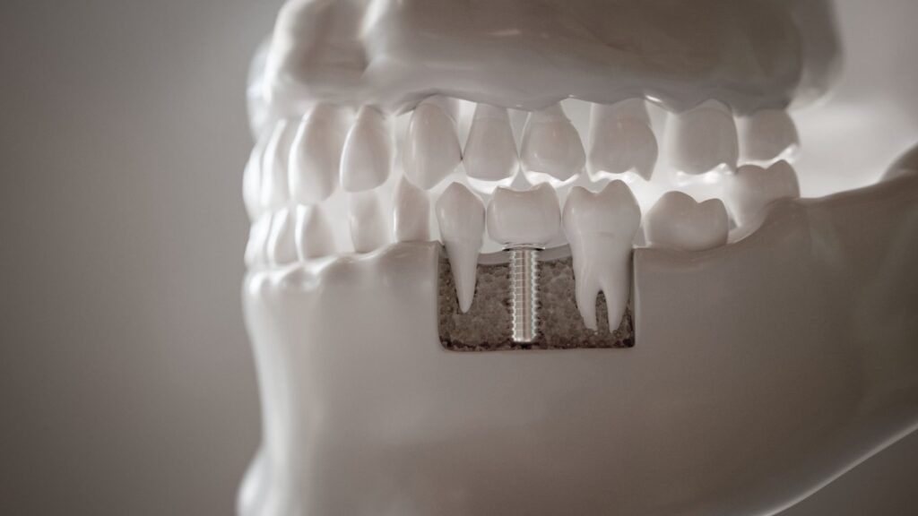 Dental Implants 3D